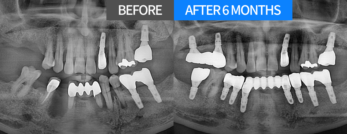 외할아버지 임플란트 수술 전후 X-ray BEFORE / AFTER