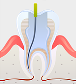 손상된 신경제거