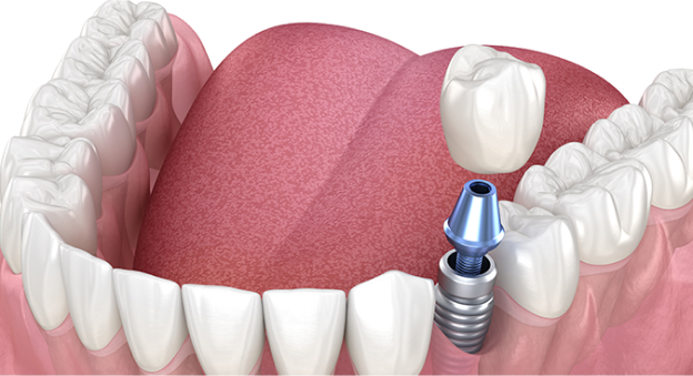 임플란트