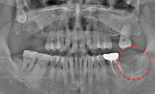 왼쪽 하악 매복 사랑니 발치 After X-Ray
