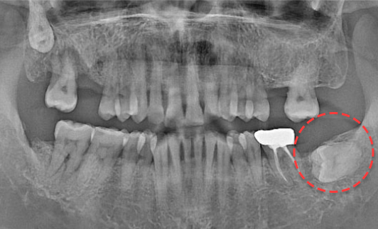 왼쪽 하악 매복 사랑니 발치 Before X-Ray