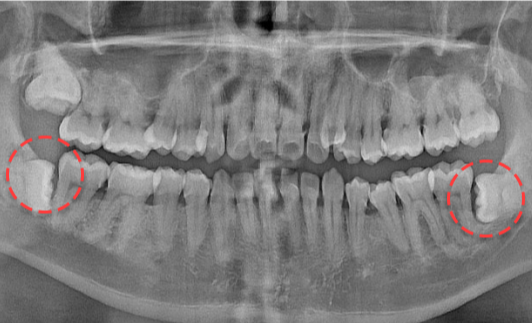 양쪽 하악 매복 사랑니 발치 Before X-Ray